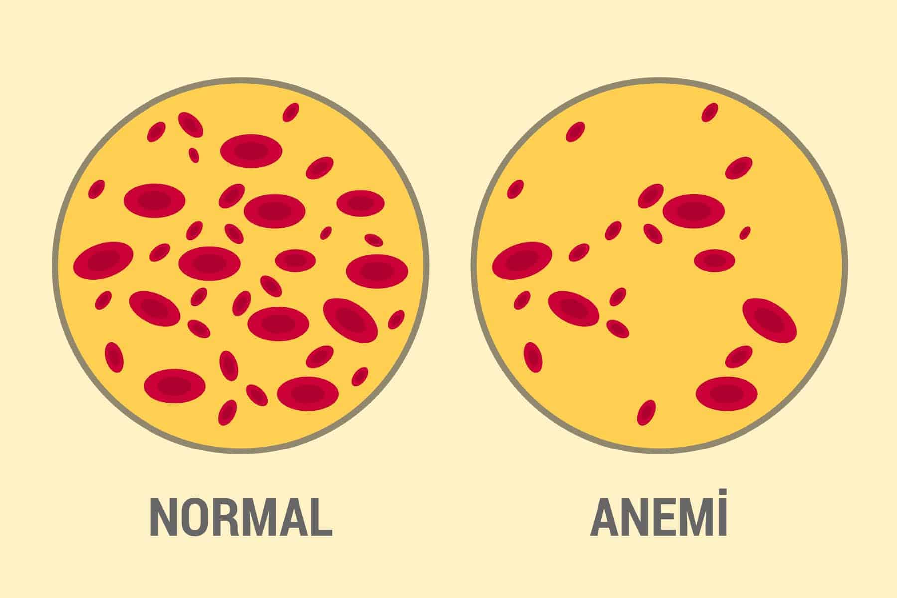 Anemi (Kansızlık)