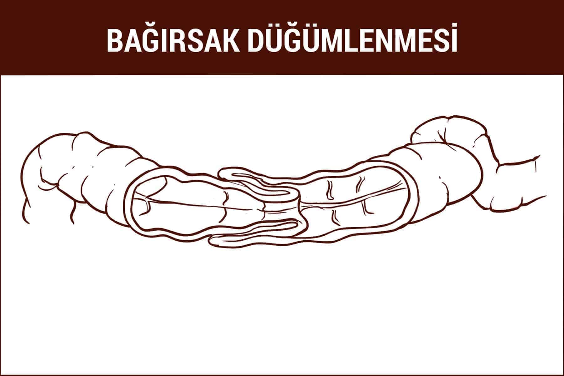 İnvajinasyon (Bağırsak Düğümlenmesi)