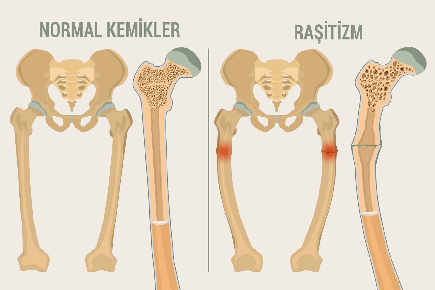 Raşitizm nedir?